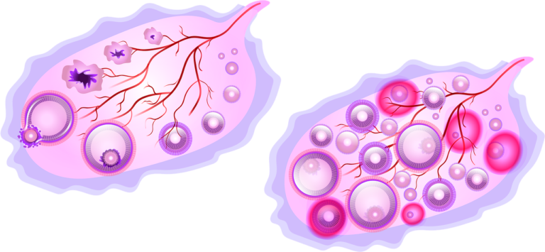Key Difference Between PCOD and PCOS